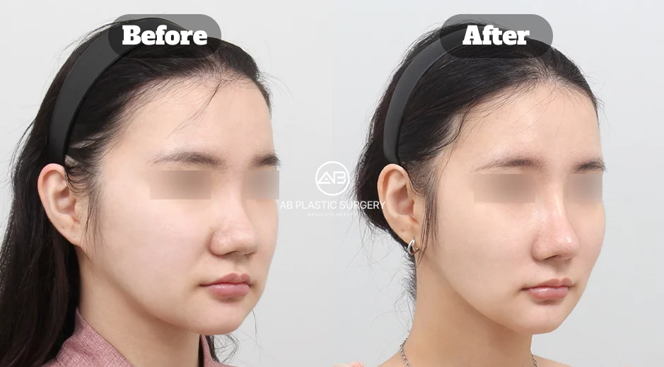 ภาพเปรียบเทียบมุมเฉียงของผู้ป่วยหญิงก่อนและหลังผ่าตัดดึงหน้าแบบควิกมินิ แสดงแก้ม กรอบหน้า และบริเวณข้างมุมปาก โดยปิดบังดวงตาและมีโลโก้ AB ตรงกลาง