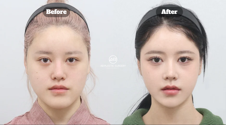 ภาพใบหน้าหญิงมุมหน้าตรงสองภาพ แสดงแก้ม แนวกราม และปลายคาง โดยมีข้อความ Before และ After และโลโก้ AB ตรงกลาง
