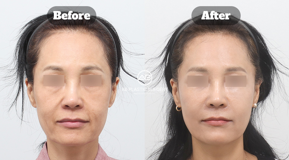ภาพเปรียบเทียบหน้าตรงของผู้ป่วยหญิงก่อนและหลังควิกมินิลิฟต์ ร้อยไหม Mint และฟิลเลอร์บริเวณโหนกแก้มกับร่องแก้ม แสดงใบหน้าส่วนล่างและบริเวณรอบมุมปาก โดยปิดบังดวงตาและมีโลโก้ AB ตรงกลาง