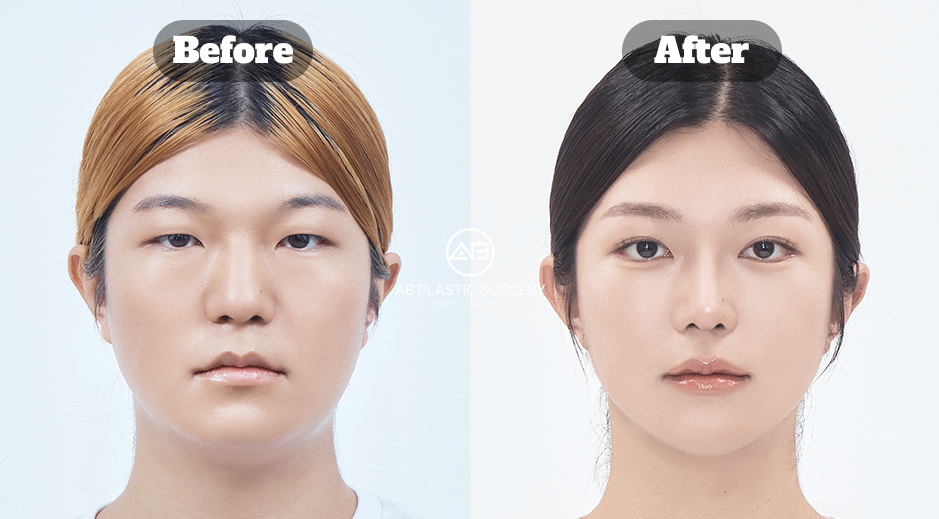 ภาพใบหน้าหญิงมุมหน้าตรงสองภาพ แสดงแก้ม แนวกราม และปลายคาง มีข้อความ Before ทางซ้ายและ After ทางขวา พร้อมโลโก้ AB ตรงกลาง