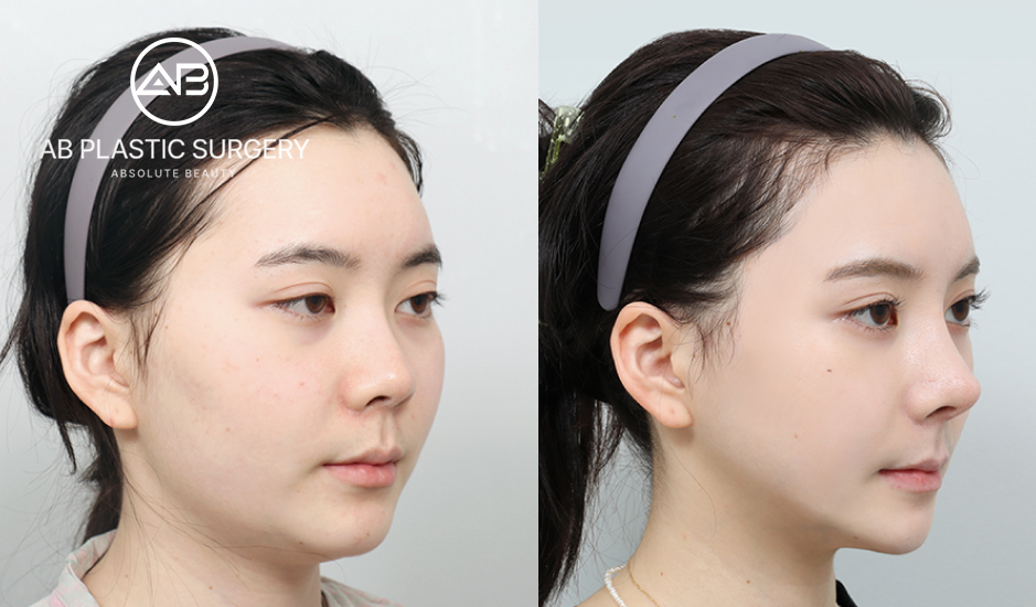 韓國整形後自然輪廓變化之女性術前術後對比圖
