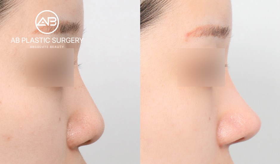 韓國整形隆鼻術前後之側顏對比圖