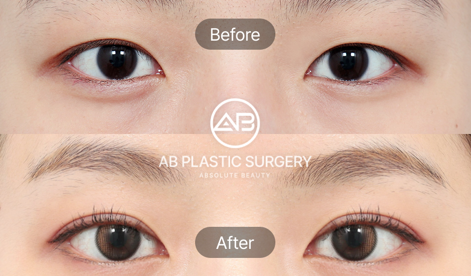 韓國雙眼皮整形前後對比圖