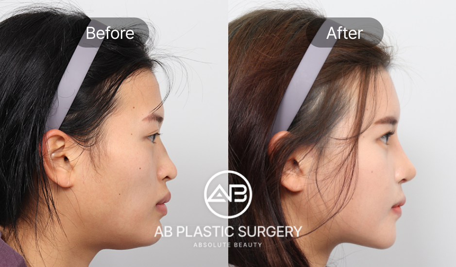 AB整形外科矮鼻案例，韓式隆鼻前後側臉對比照