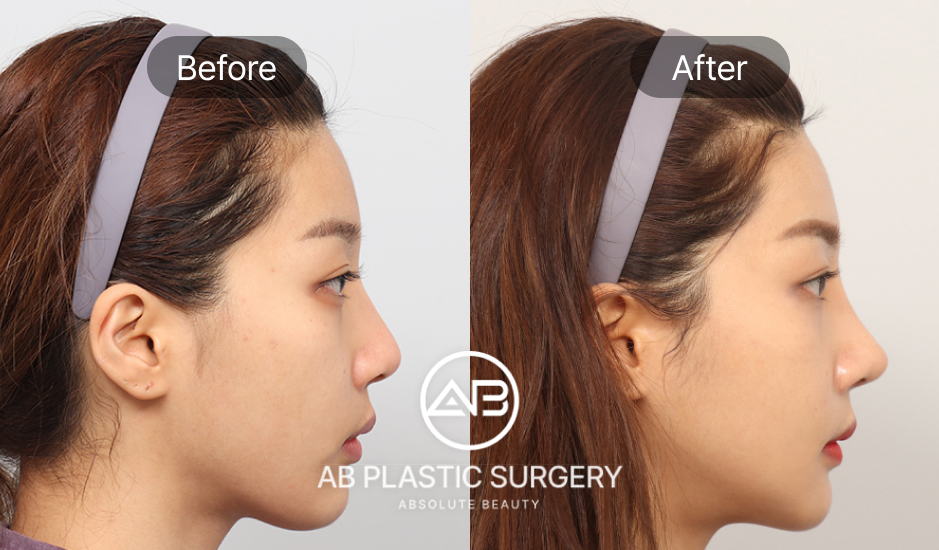 AB整形外科隆鼻手術前後對比圖
