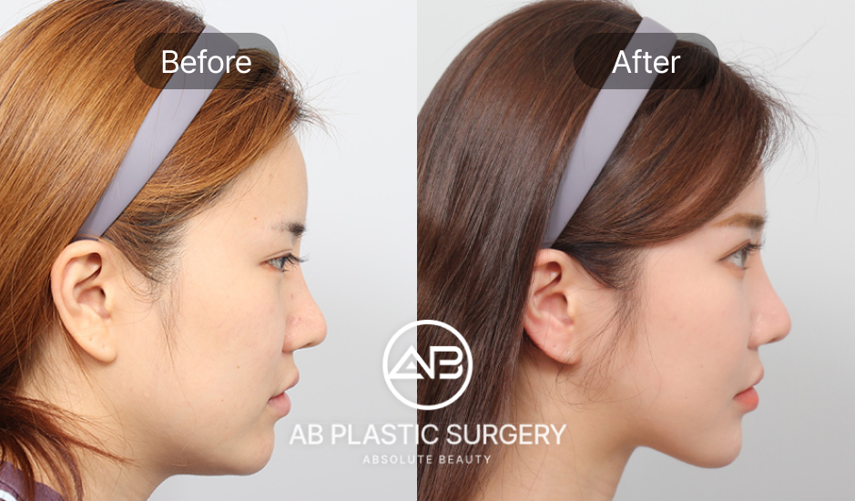 AB整形外科自體軟骨隆鼻前後對比照，呈現自然柔和的鼻型變化