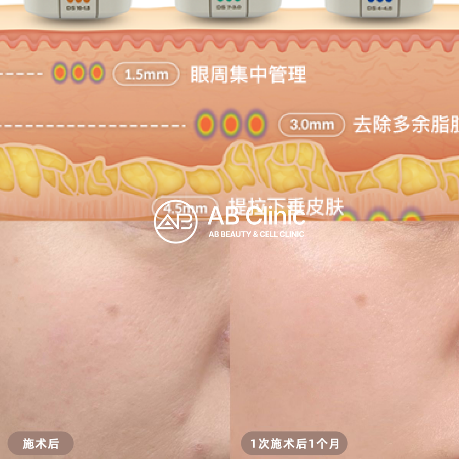 Thermage 熱瑪吉的高頻作用深度示意圖與實際療程前後對比圖