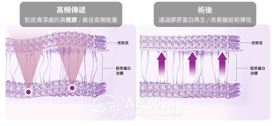 熱瑪吉高頻能量穿透真皮層與膠原層原理示意圖