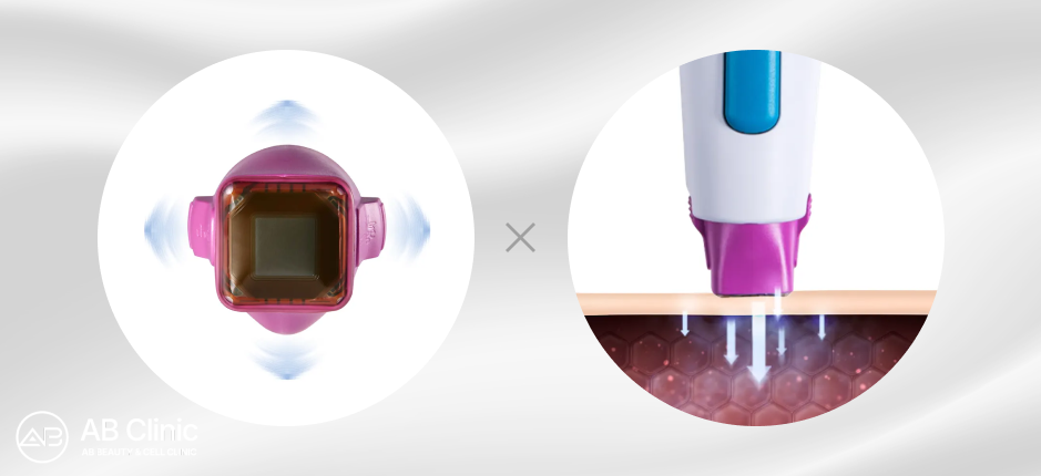 Thermage FLX探頭與能量傳導示意圖，展現冷卻震動技術降低熱瑪吉疼痛感，提升施術舒適度。