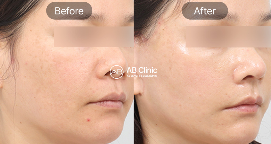 AB整形外科熱瑪吉實際施術前後照片