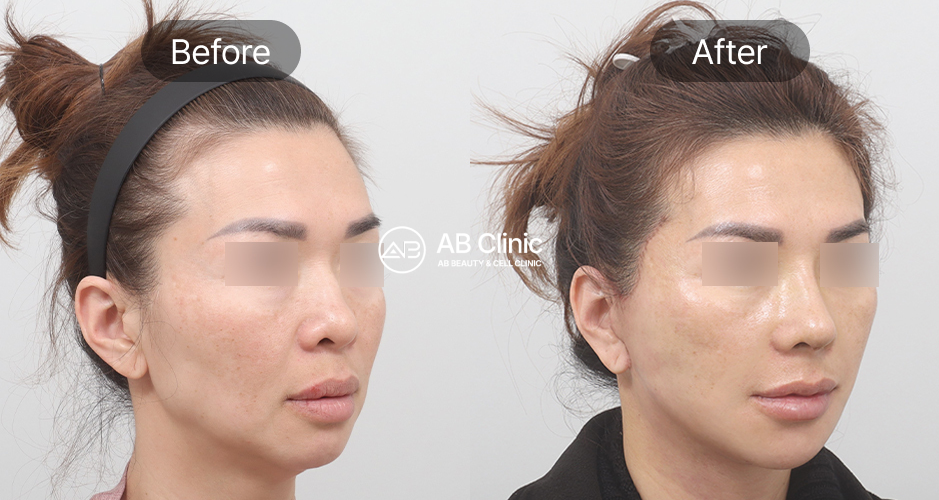 韓國皮膚科療程前後對比照片