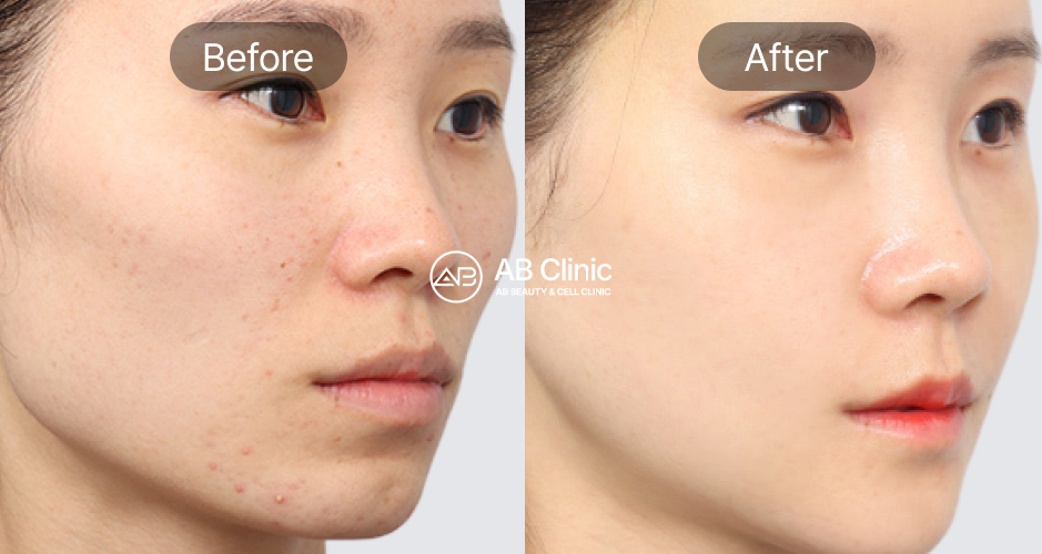 韓國醫美療程前後變化照