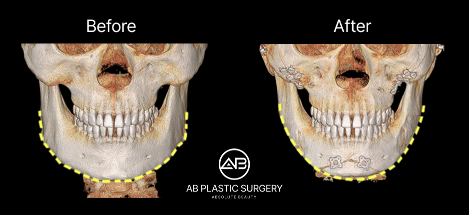 下頜角手術CT影像比較 – 黃色標註示意