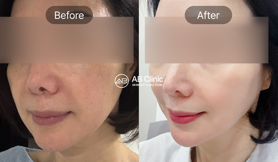 AB皮膚科基礎護理前後對比照片｜深層清潔、保濕、美白效果明顯