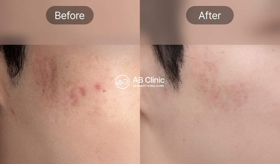 AB皮膚科痘痘肌管理前後照片