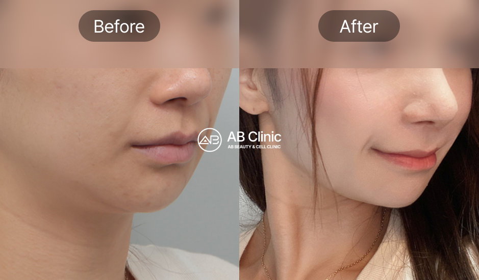 AB皮膚科醫學級療程前後照片，膚質更緊緻透亮