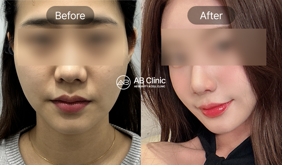AB皮膚科快速膚質改善前後照片，短期呈現透亮細緻肌膚
