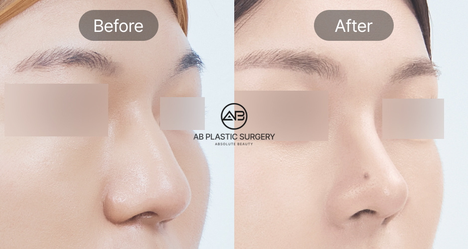 韓國小翹鼻整形前後照片，輕度駝峰鼻與鷹鉤鼻改善案例圖片