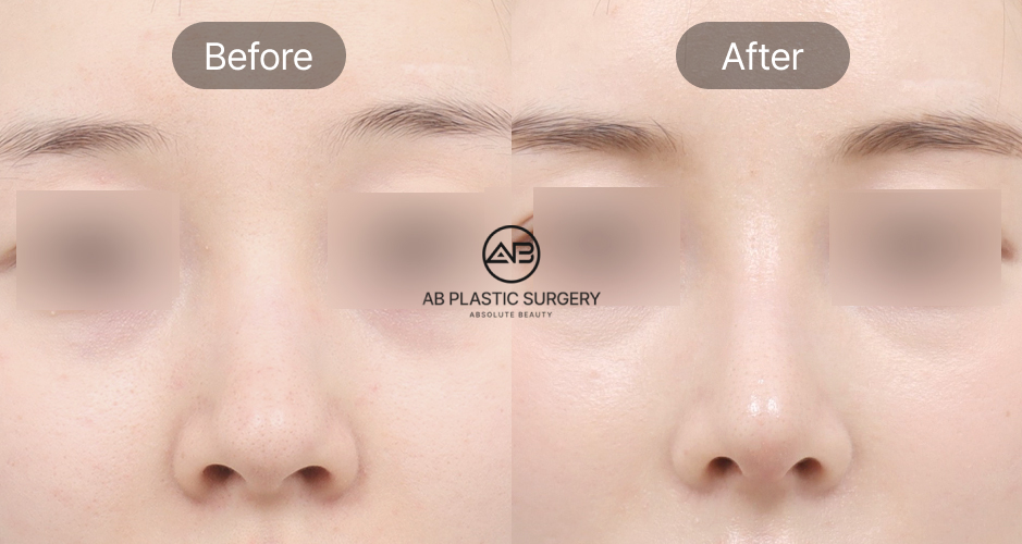 韓國小翹鼻整形前後對比照片，鼻翼寬大與鼻頭肥厚改善案例圖片