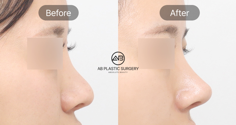 韓國小翹鼻整形前後對比照片，低鼻樑與圓鈍鼻頭改善案例圖片