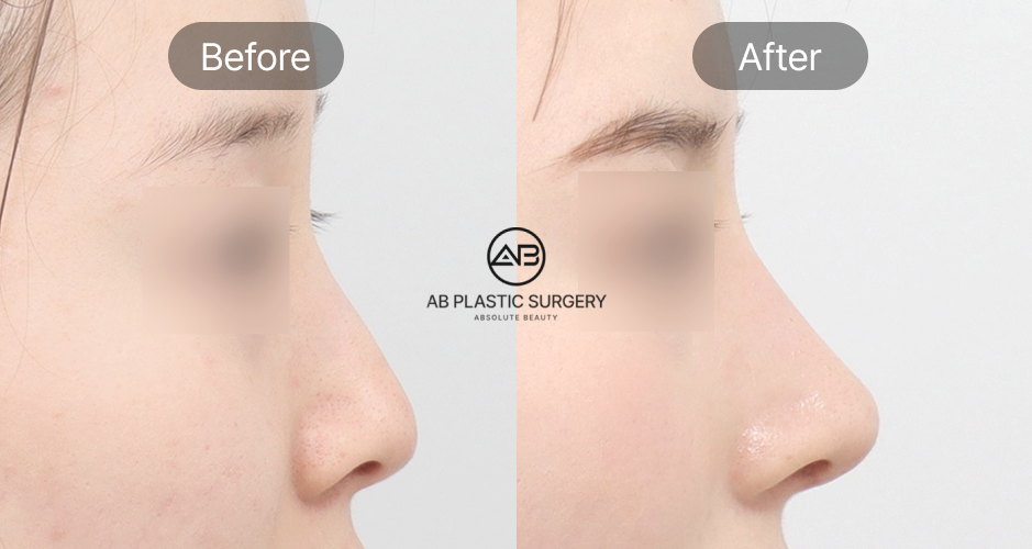 韓國小翹鼻整形前後照片，駝峰鼻改善與鼻背線條矯正案例圖片