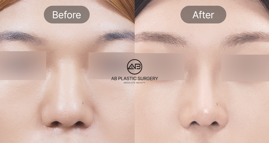 韓國小翹鼻整形前後照片，鼻翼寬大與鼻頭肥厚改善案例圖片