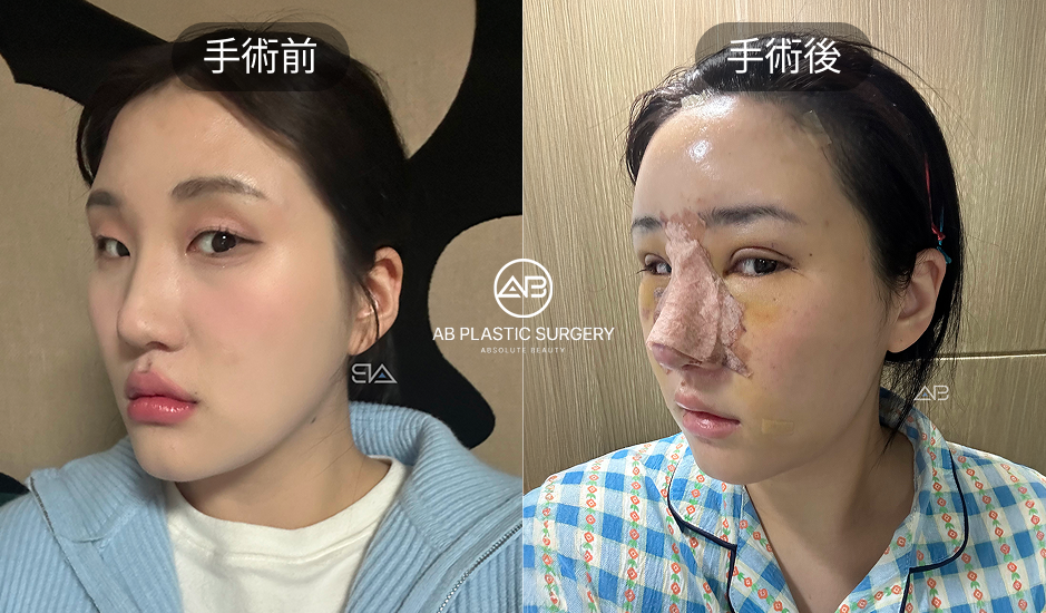 韓國小翹鼻整形術後腫脹與瘀青案例，AB整形外科恢復期實拍照片