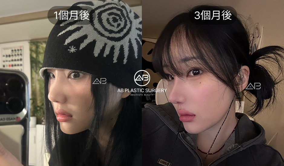 韓國小翹鼻整形術後1至3個月穩定期案例，鼻尖自然柔和效果展示