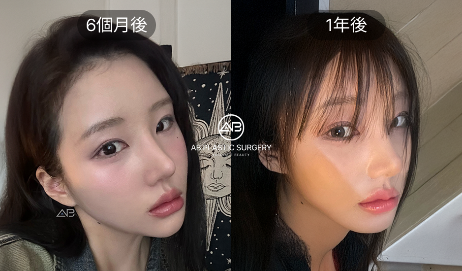 韓國小翹鼻整形術後6個月完全恢復案例，鼻尖線條自然持久效果展示