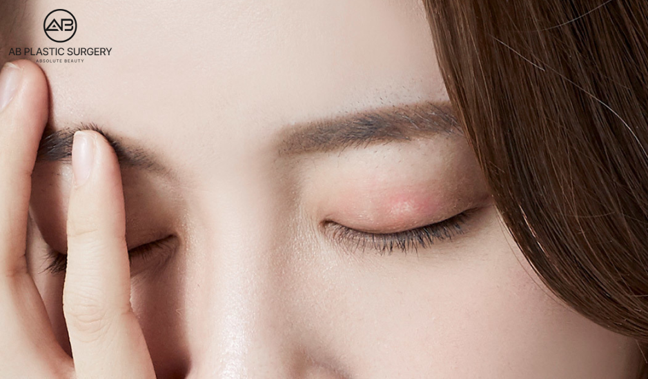 杏眼手術術後眼皮腫脹示意圖