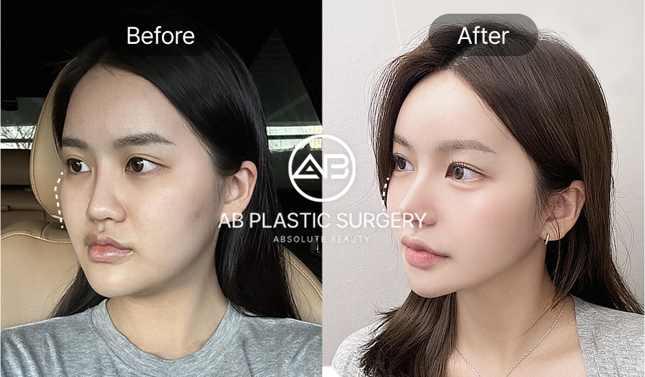 韓國AB整形外科 V臉手術 前後照片