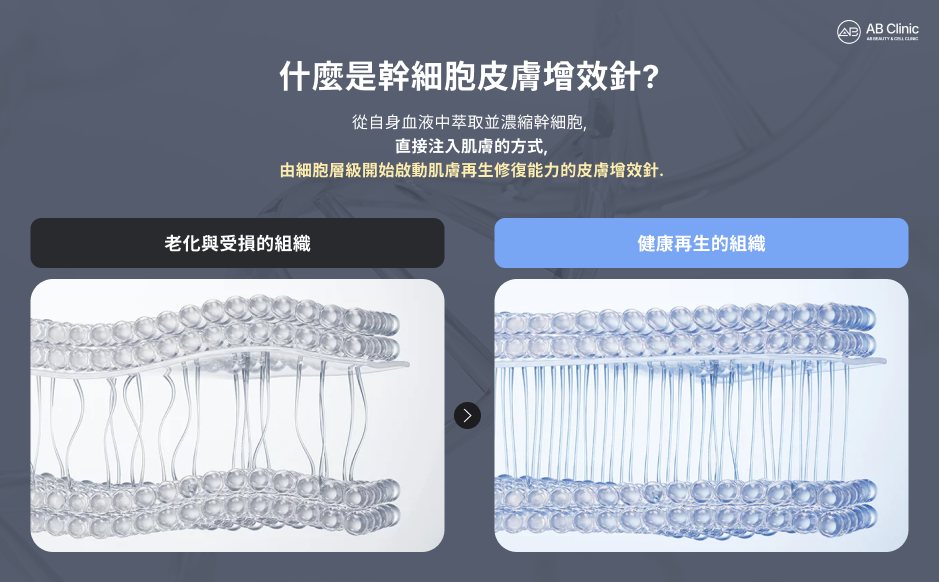 幹細胞水光針原理示意圖，說明透過自體血液來源幹細胞促進受損與老化肌膚組織修復，幫助啟動肌膚再生與結構改善的過程