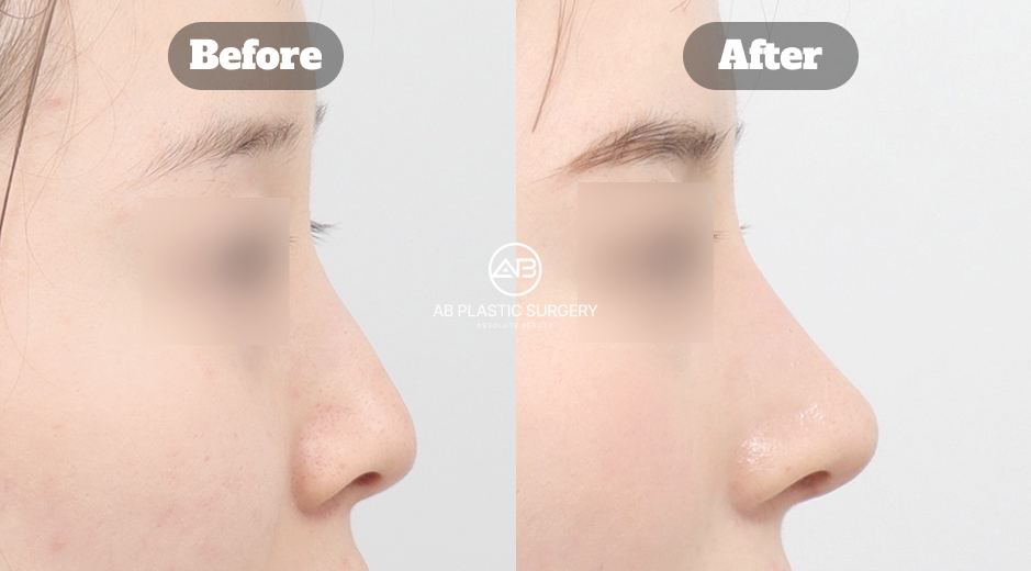 韓國低鼻與駝峰鼻整形改善示意影像