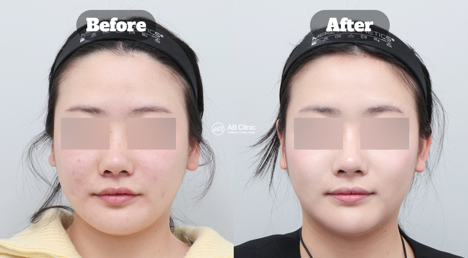 韓國音波拉提（Ulthera）、熱瑪吉（Thermage）與麗珠蘭施術前後效果評論