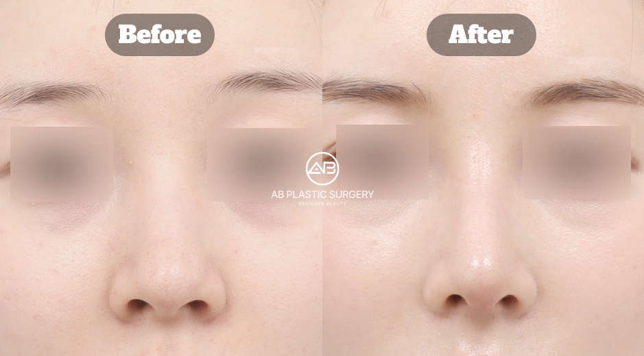 韓國AB整形外科低鼻與駝峰鼻整形前後結果影像