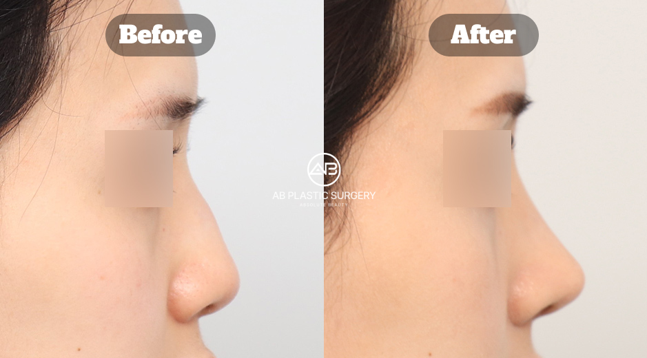 韓國無假體隆鼻與駝峰鼻整形前後影像