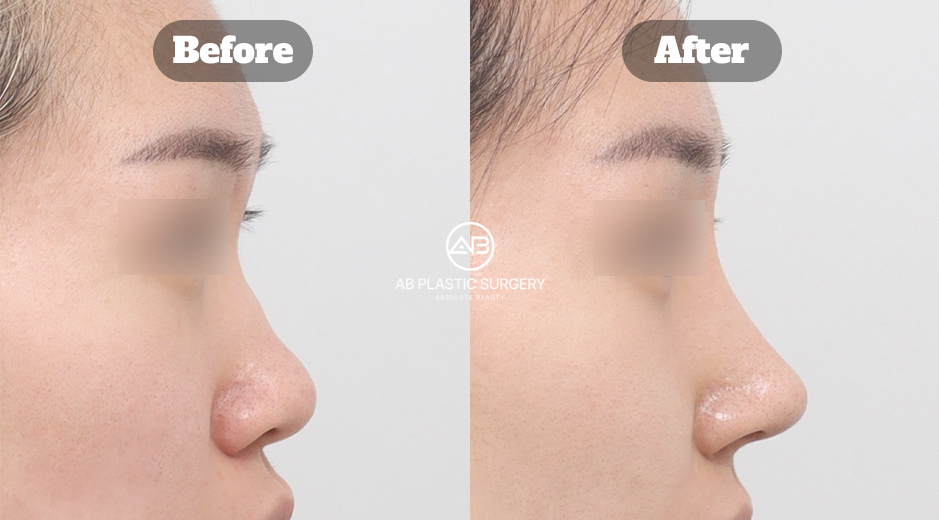 韓國AB整形外科蒜頭鼻、短鼻與駝峰鼻整形前後結果影像