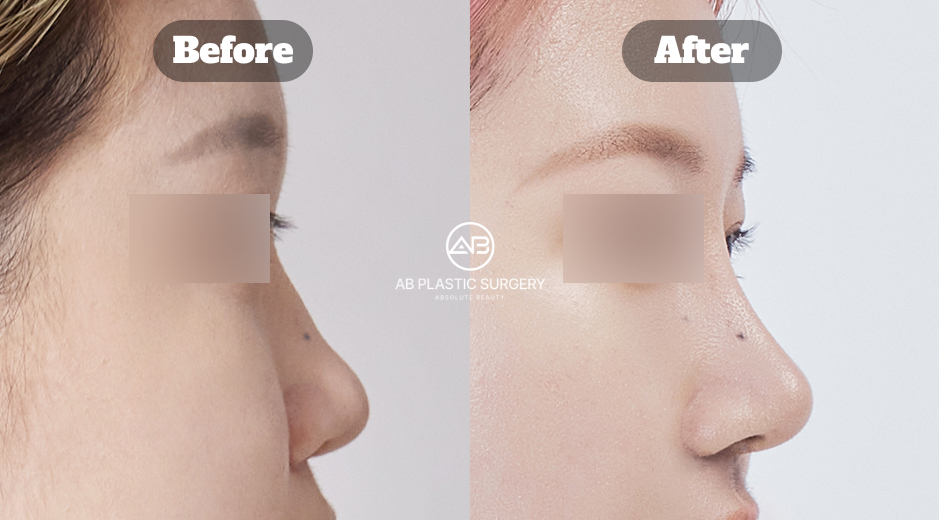 韓國AB整形外科女性蒜頭鼻、歪鼻矯正、駝峰鼻與鼻翼縮小整形前後影像