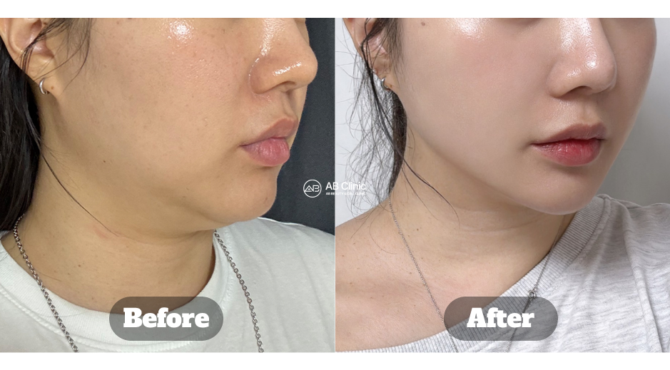 韓國皮膚科 Thermage 電波拉提施術前後評價