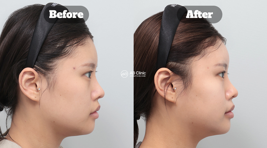 韓國AB皮膚科 音波拉提與麗珠蘭 真實前後側臉對比