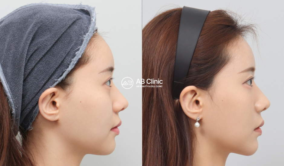 韓國醫美療程前後對比評價：Ulthera 音波拉提、Shurink 緊膚與下巴填充實際改善案例