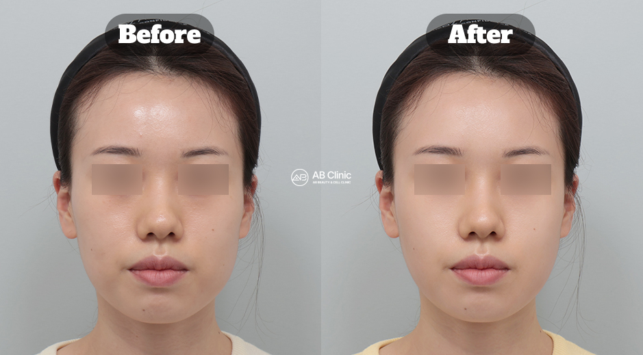 韓國AB整形外科皮膚科療程 波坦莎與瑞思諾維水晶 術前術後實際案例