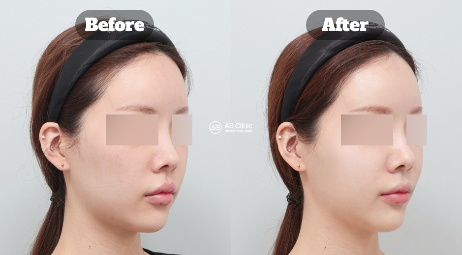 韓國AB皮膚科 無痛注射麗珠蘭希拉 真實前後改善側臉
