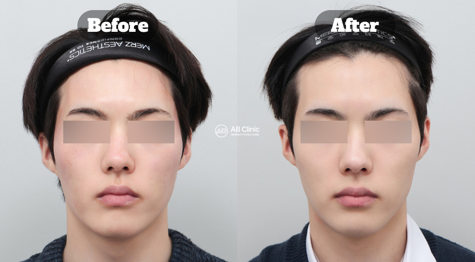 韓國AB整形外科皮膚科療程 波坦莎與喬雅露 術前術後實際案例