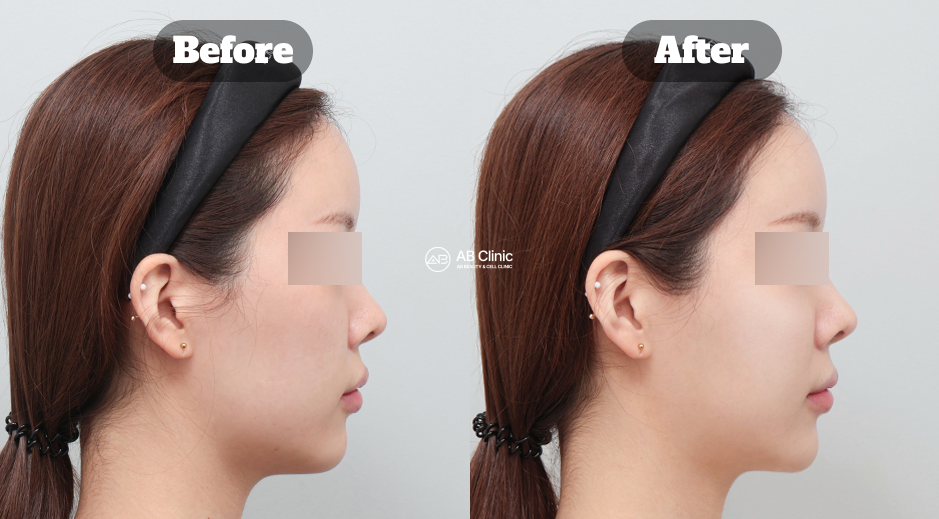 韓國AB皮膚科 麗珠蘭希拉 真實前後側臉結果