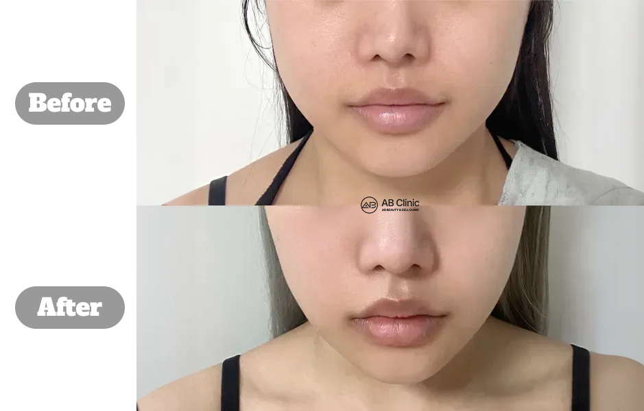 韓國AB皮膚科 麗珠蘭 真實治療前後對比