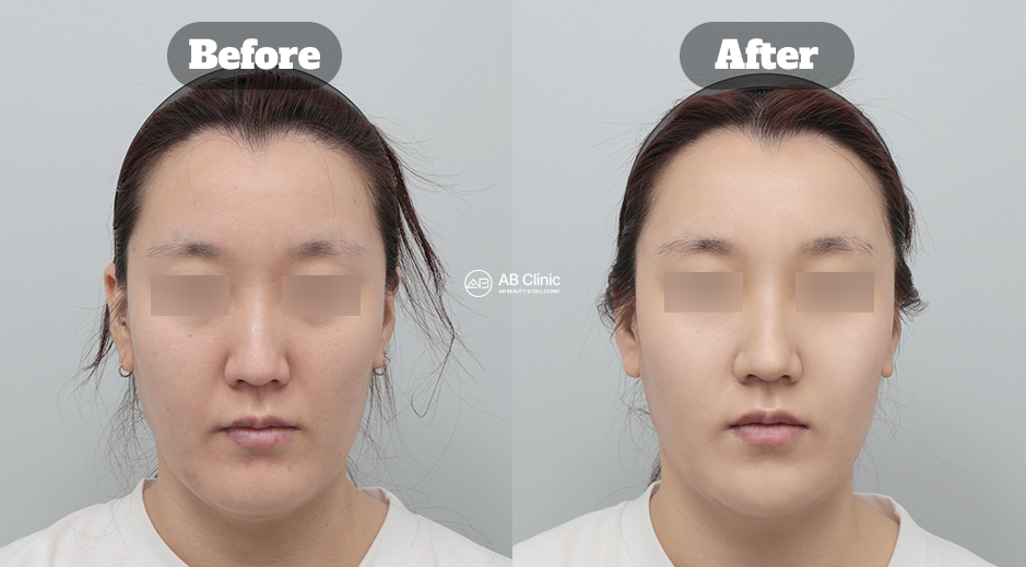 韓國AB整形外科皮膚科療程 波坦莎與瑞思諾維水晶 術前術後實際案例