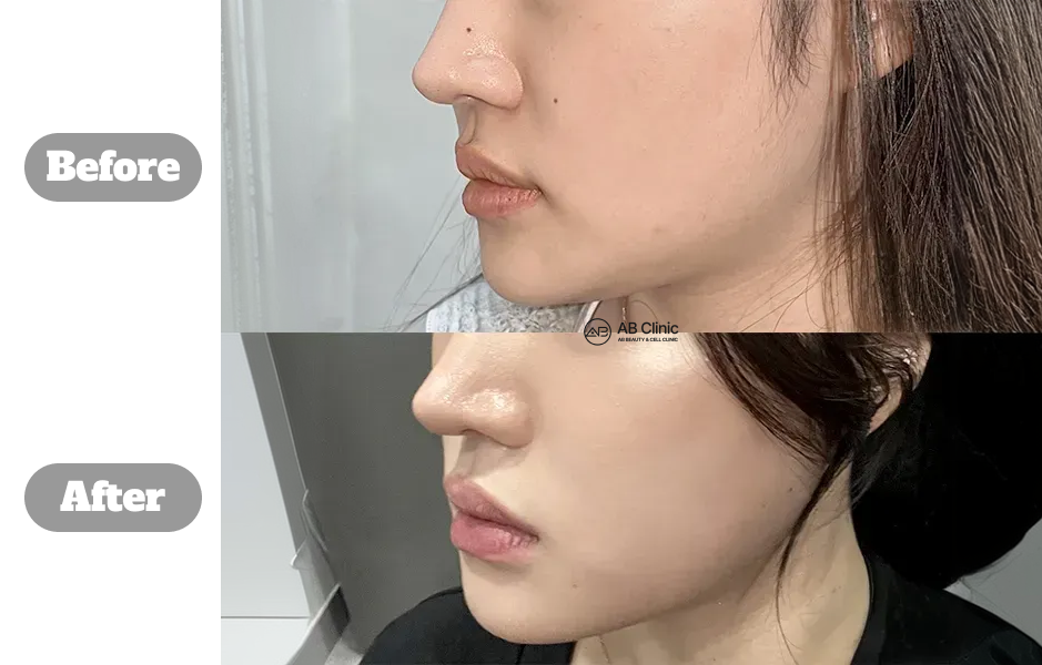 韓國AB皮膚科 麗珠蘭 真實前後側臉對比