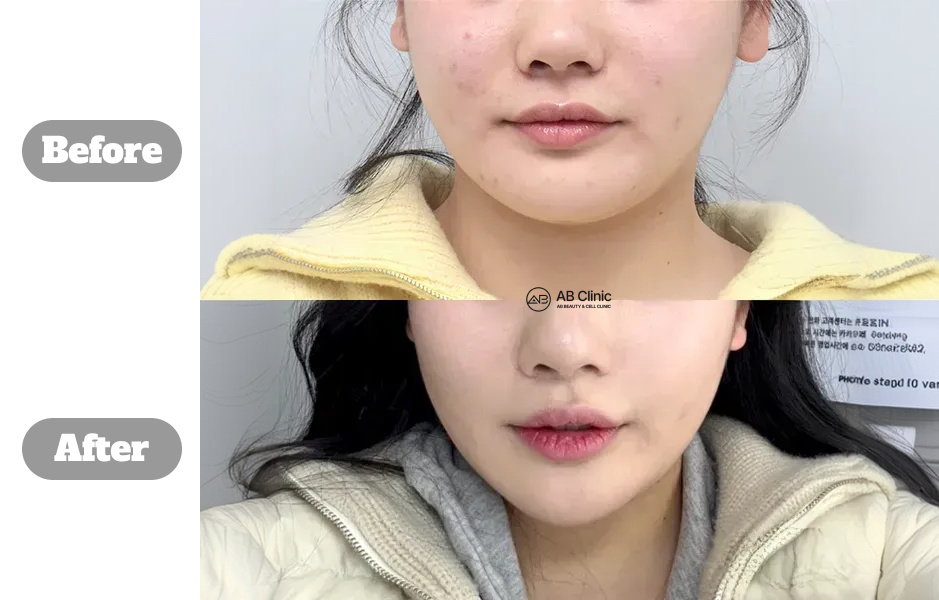 韓國AB皮膚科 麗珠蘭 真實前後下臉對比