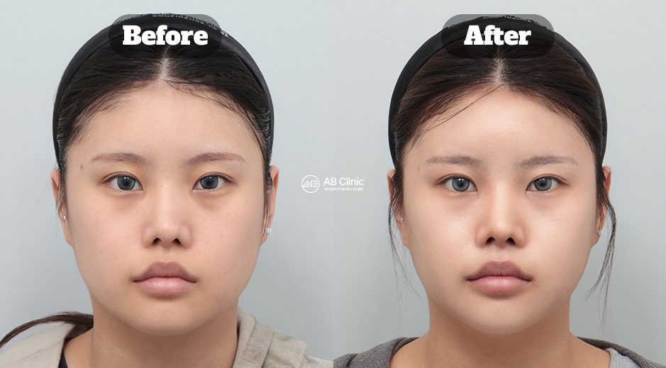 韓國AB皮膚科 音波拉提與麗珠蘭 真實前後臉部對比